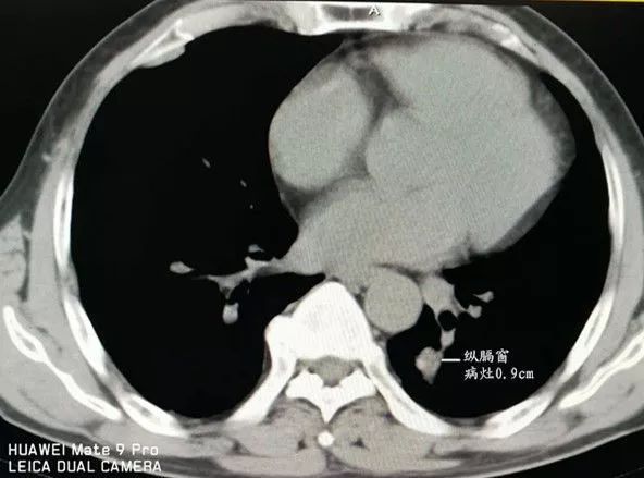 纵隔窗示该病灶最大横径9mm,距腹主动15mm,距左肺下静脉属枝5mm,距皮