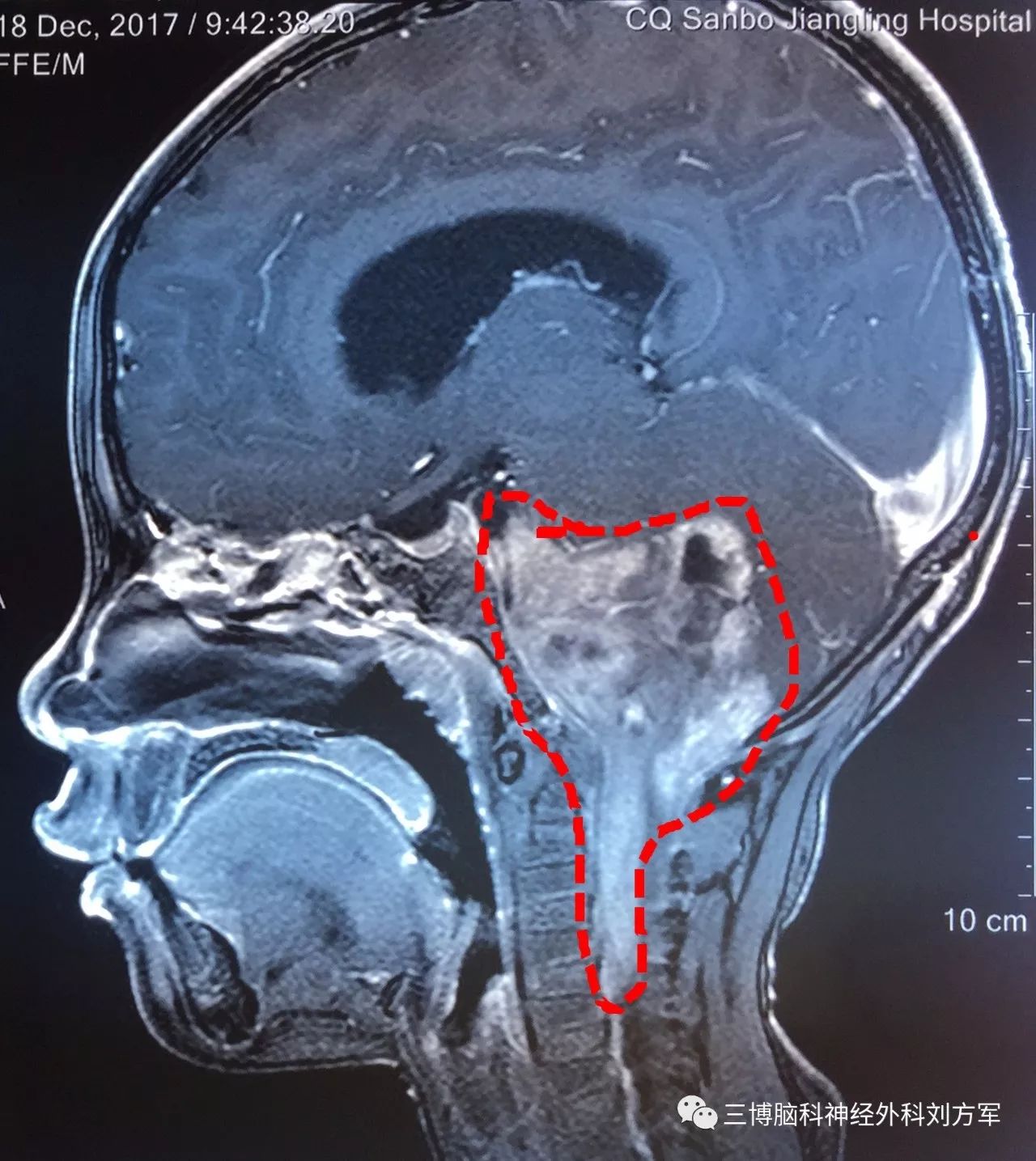 颅脑CT解剖-MedSci.cn