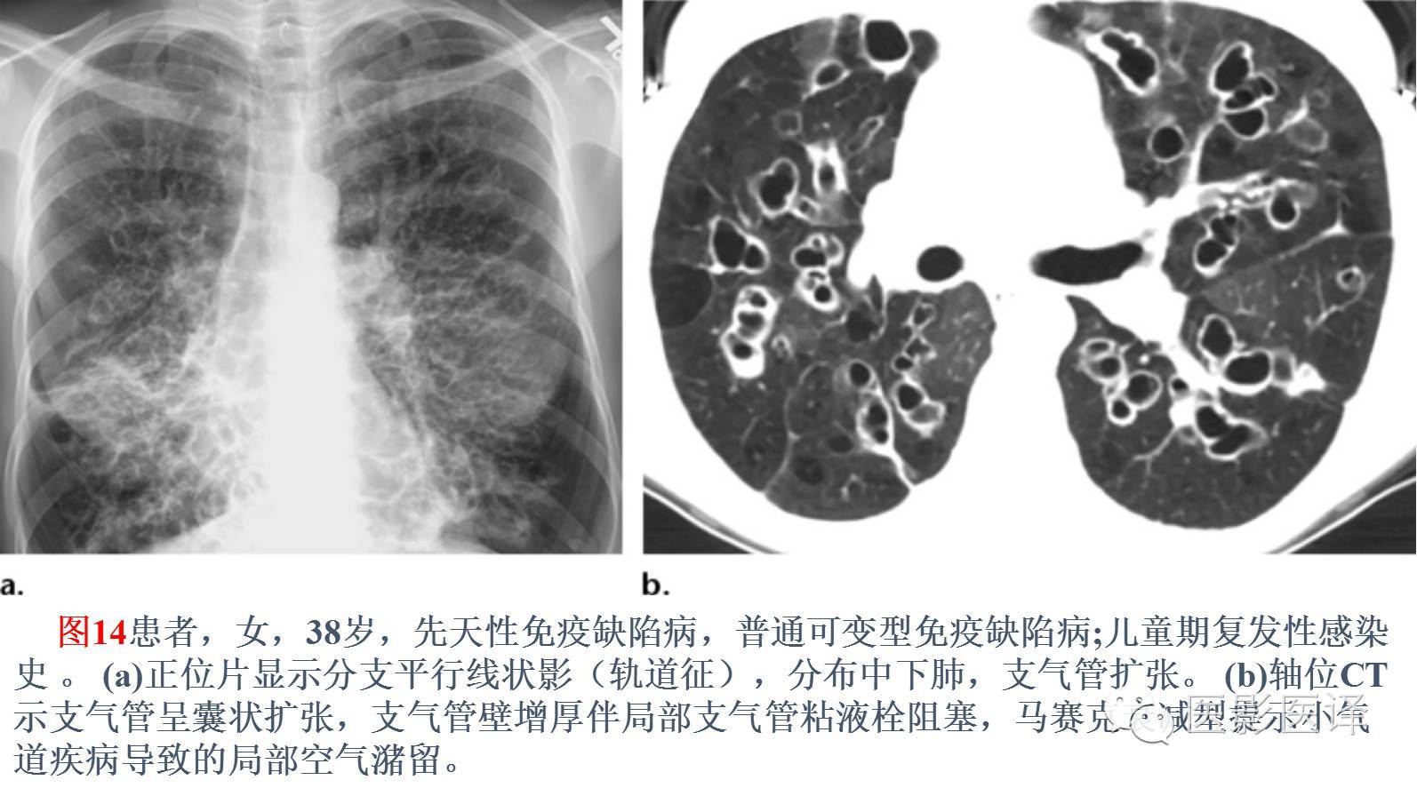 虽然免疫缺陷病的支气管扩张症(表现)最初被认为是反复感染的直接结果