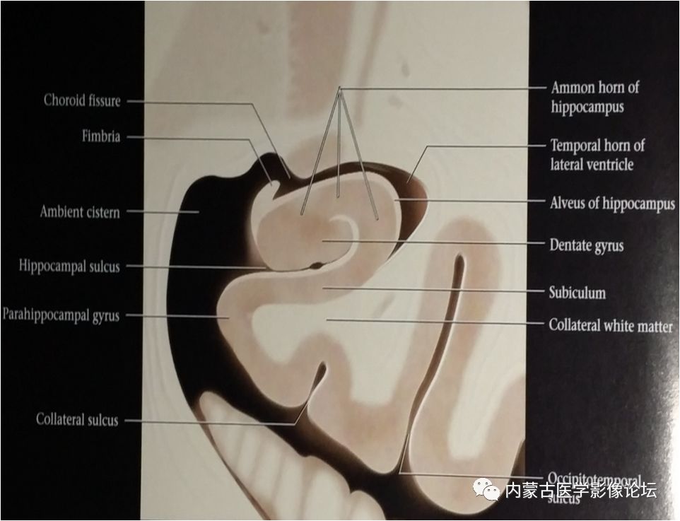 在海马结构发育较好的颞中平面,作一个大脑半球的冠状切面,海马结构