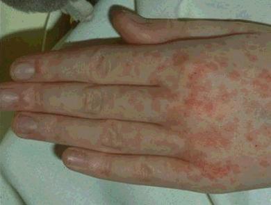 皮疹: 感染了病毒性肝炎,有人可以发生皮疹.常见的有红斑,斑丘疹.