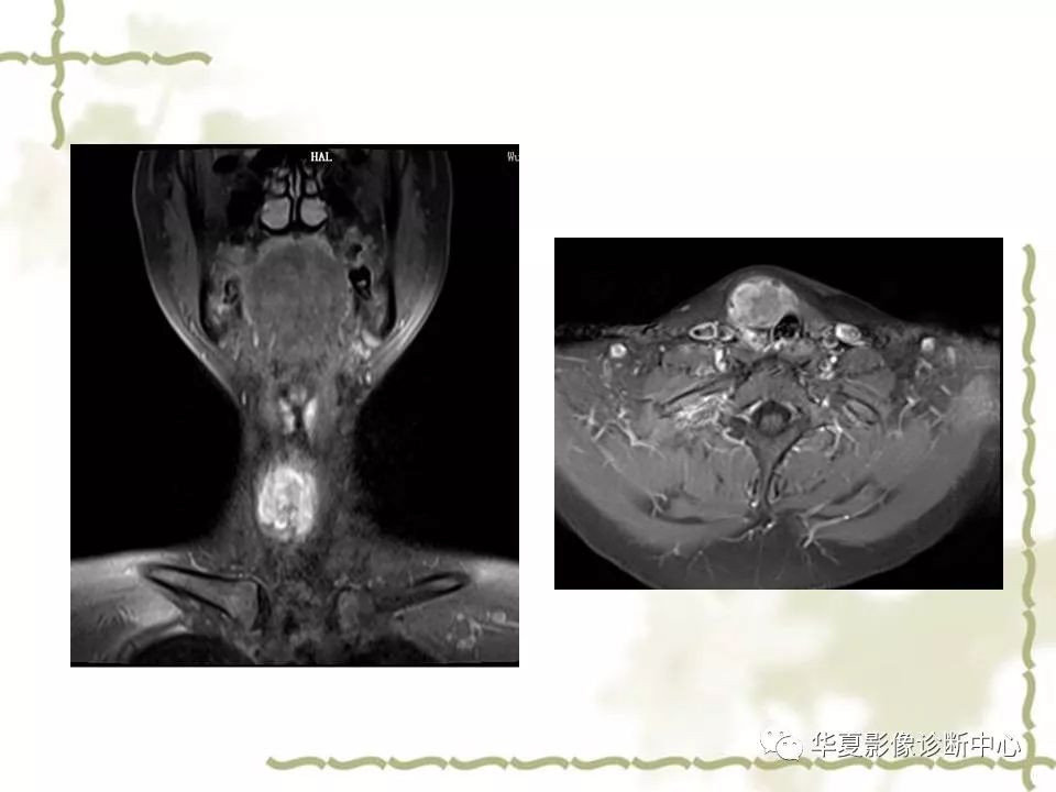 甲状腺解剖及相关疾病影像诊断技巧