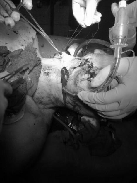 男子脖子被割12厘米伤口,手术4小时重建喉咙!