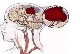 脑溢血——是由于脑血管壁破裂,血液渗出血管外,压迫脑组织而发生的.