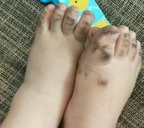 网友:这脚是畸形吧,应该去医院看看