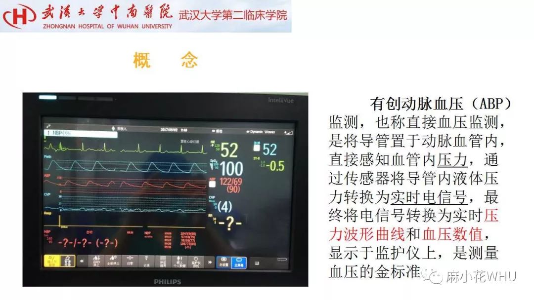 如何做好有创动脉血压监测及其波形分析?史上最详细的解读来了!