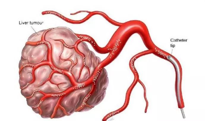 【医救治】微创介入的"三把利器",让肝癌无处可逃!