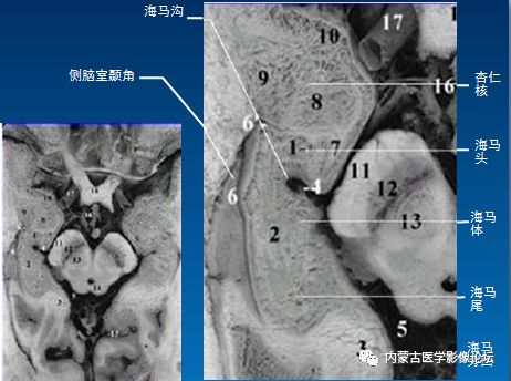 头部因其上缘有海马趾,而呈波浪形外观 体位于海马沟与脉络膜裂之间