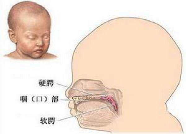 你的孩子是被上帝吻过的天使么 一句话科普唇腭裂