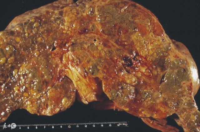 医生:预防肝癌别忘了这4个