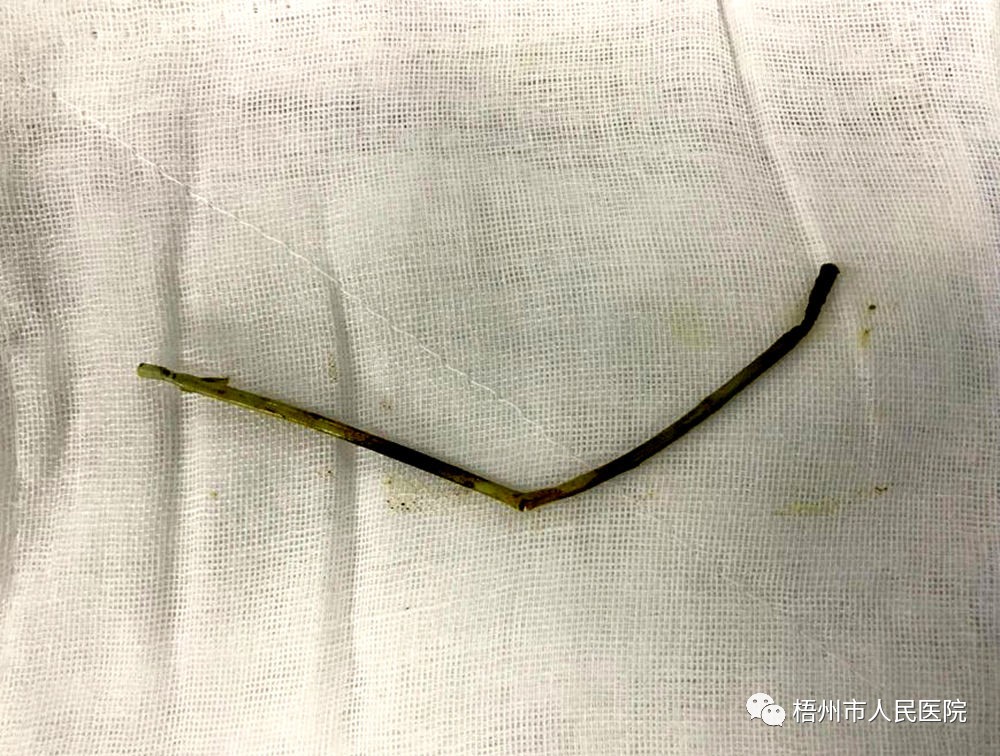 梧州市人民医院微创手术取出老年患者胆总管内5cm的支架管