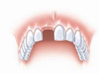 牙齿缺了一颗怎么办