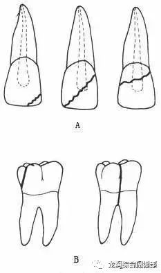 后牙冠折(资料图)
