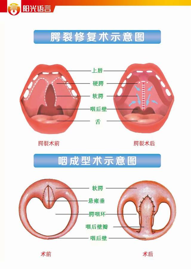 千万别大意 腭裂儿童手术后更重要的事情