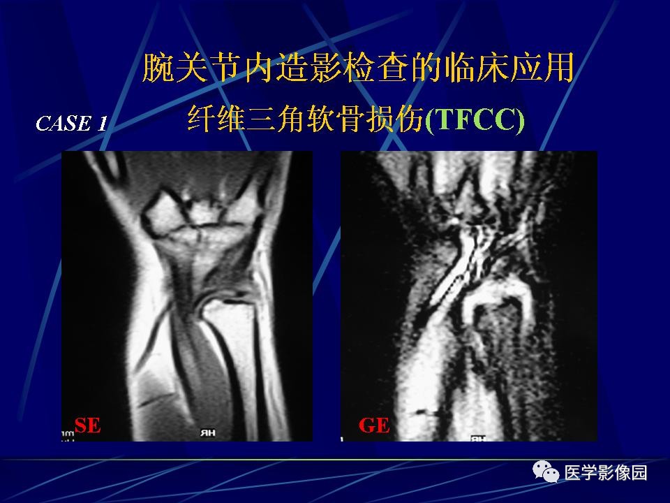 腕关节mri影像诊断丨影像天地