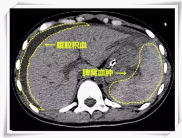 于当天晚上对女童实施了1个多小时的紧急手术(剖腹探查:脾窝出血灶缝