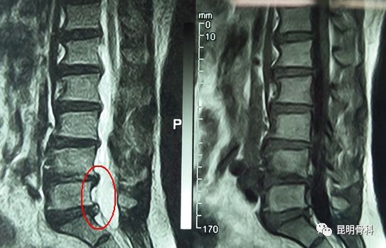 腰椎管狭窄光学影像资料▼