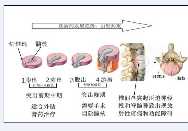 腰间盘突出微创手术是什么原理_腰间盘突出微创手术图(2)