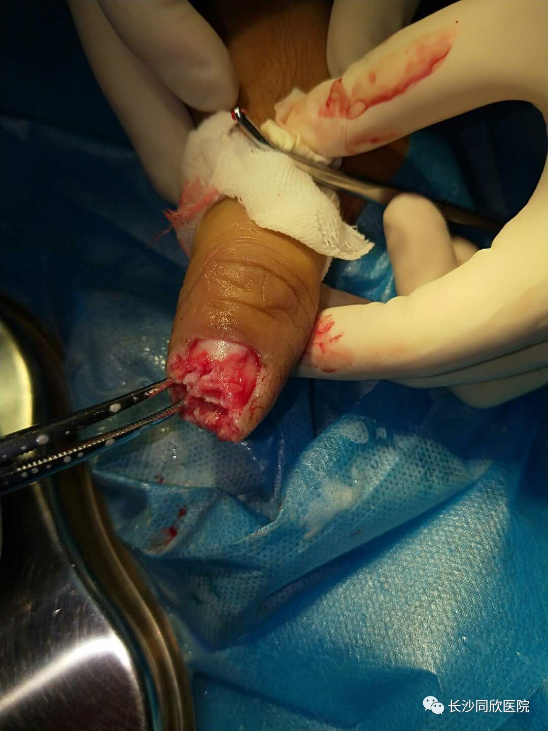 可提供不同修复方法:邻指皮瓣修复,岛状皮瓣,带蒂腹部皮肤等等,但患者