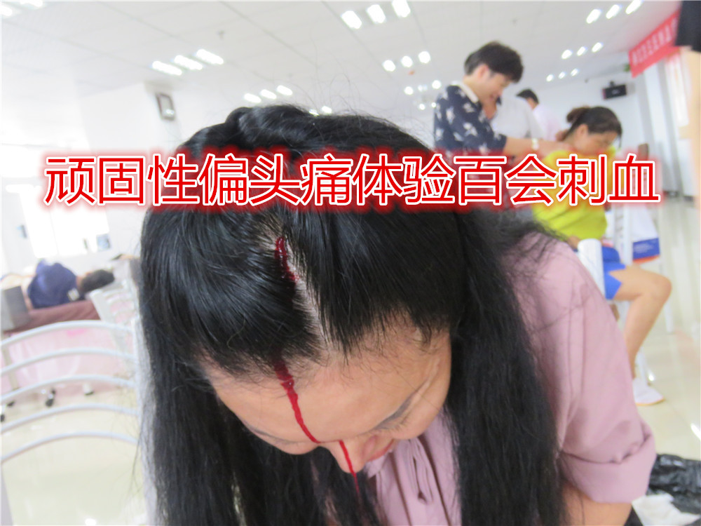 脉立方王氏刺血:三棱针刺络放血与神经性头痛