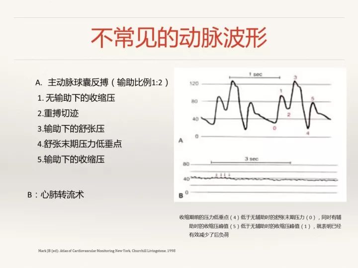 血压监测与波形