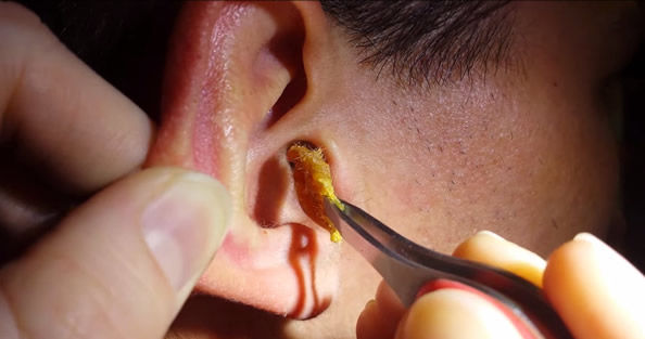 1 不要自己掏耳朵 由于耳道深且呈弯曲状,自己掏耳朵容易损伤耳道