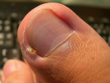 一种常见病,是甲沟或其周围组织德急,慢性感染,常发生在指(趾)甲周围
