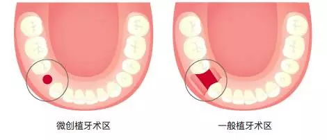 种植牙齿是什么哪三样种植技术最先进？(图2)