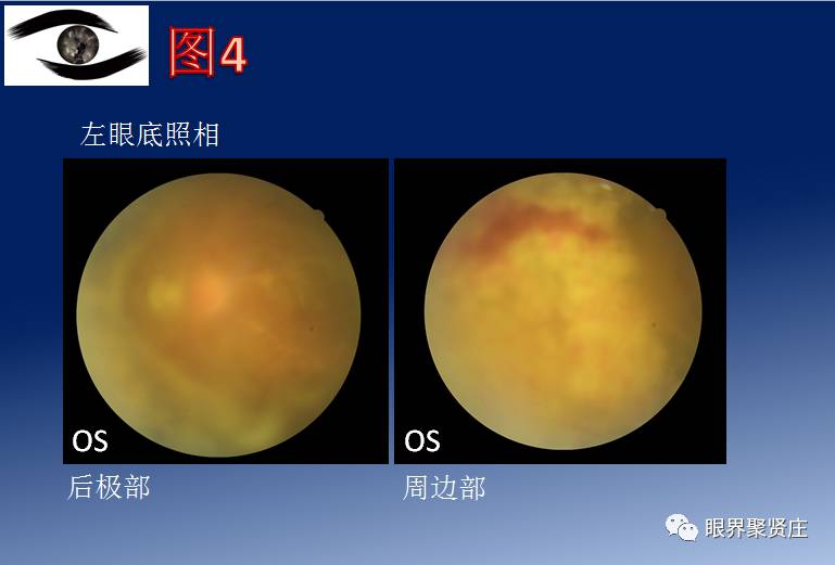 看图识病九宫格系列|葡萄膜炎
