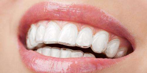 牙间隙大怎么解决?精准隐适正畸让你的牙齿悄然变整齐