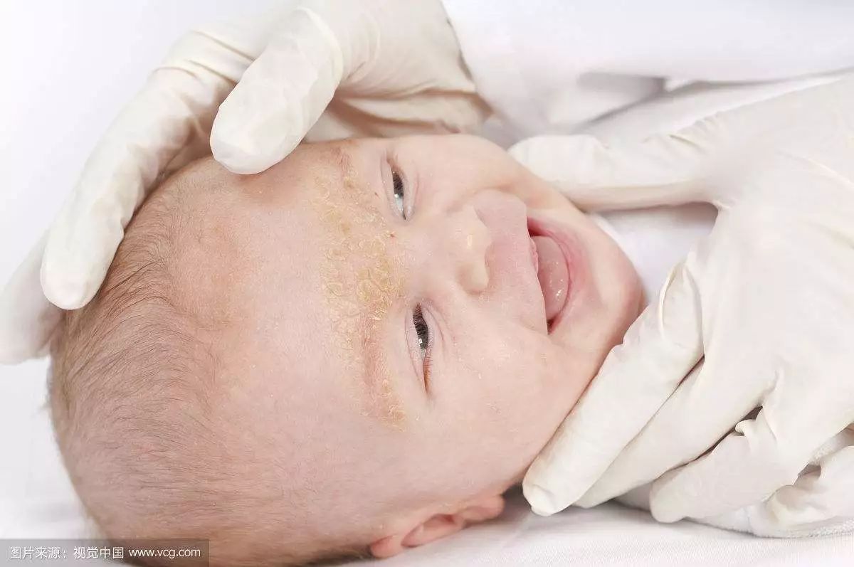 宝宝起了湿疹用什么药好？