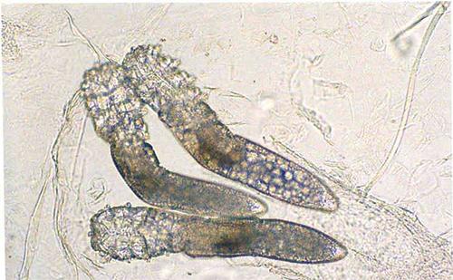 鼻子总出油还挤出白色分泌物,有4症状,一个毛囊里有6只蠕形螨
