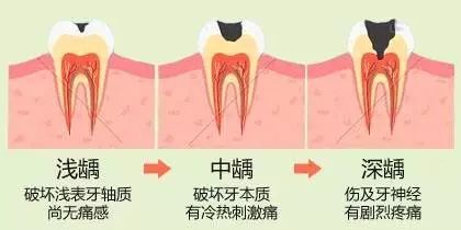 蛀牙不补?那就等着掉牙吧