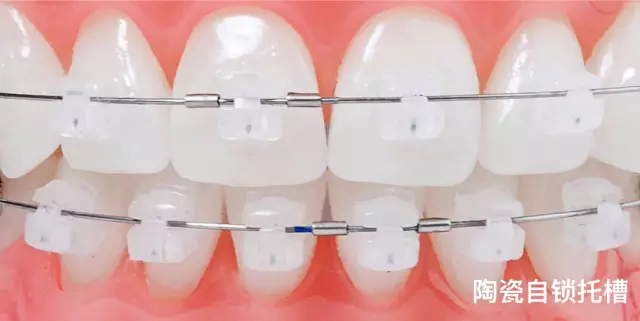 详细介绍:金属托槽矫正的优点是技术非常成熟,矫正过程中移动牙齿的