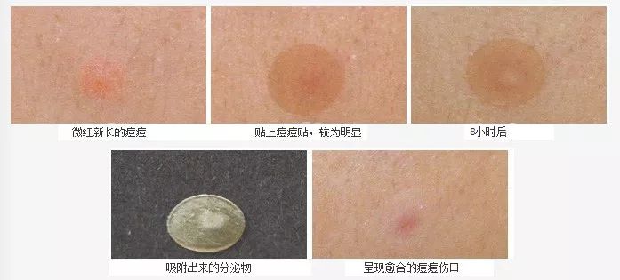 痘痘贴的原理是什么_痘痘贴是什么   1.是一种特殊亲水性的水胶体,可吸附分泌物.