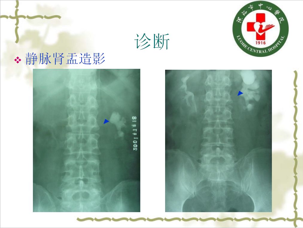 直肠指诊可能发现后尿道结石 b型超声 x线检查 治疗 舟状窝结石 推挤