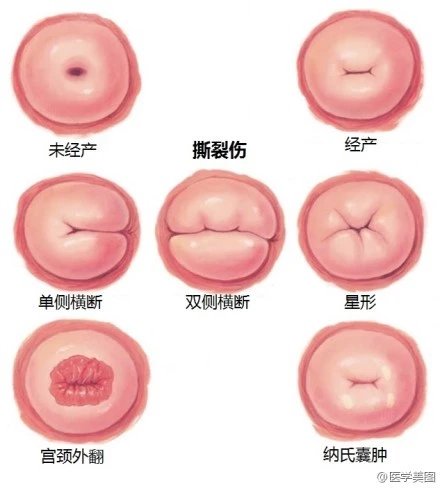 宫颈口形态正常变异20.各种常见子宫畸形19.