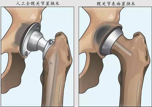 南充东方医院成功为一名高龄患者实施人工半髋关节置换术