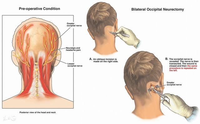 头痛原因的解剖学分析