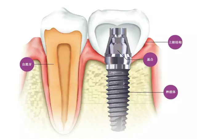 种植牙齿是什么哪三样种植技术最先进？(图5)