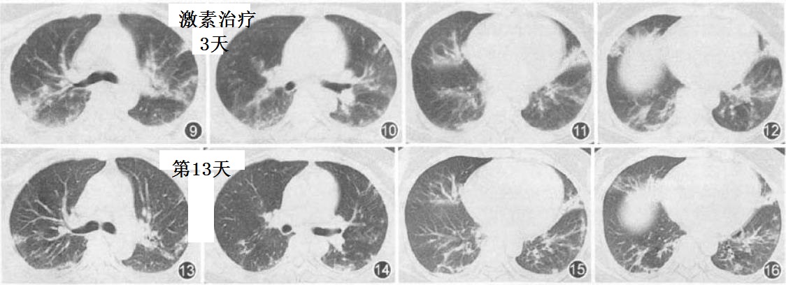 蔡后荣等大侠的报道:伴肺炎与低氧血症的新型甲型h1n1流感二例报告