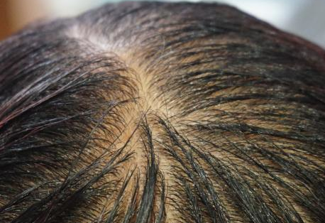 专家:男性脂溢性脱发3年以内能治好