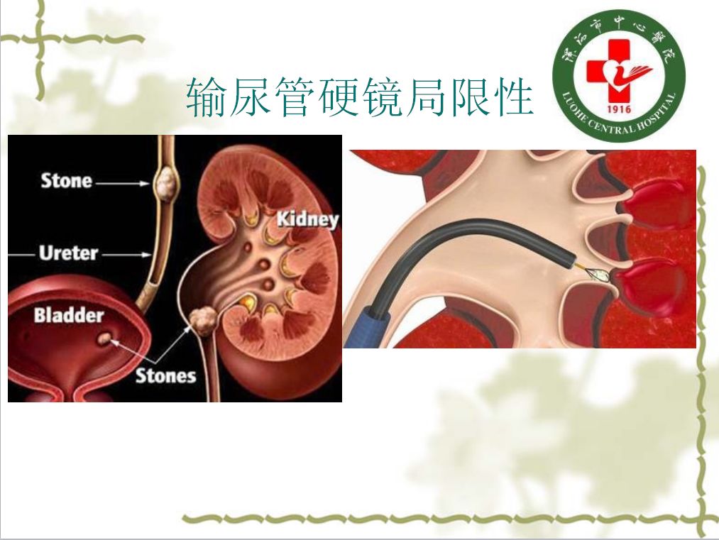 b型超声x线检查治疗舟状窝结石推挤或钳出前尿道结石推挤,钳出尿道镜