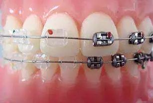 其实现在的牙齿正畸技术已经很成熟 牙套也有不少"新套路" 一 非自锁