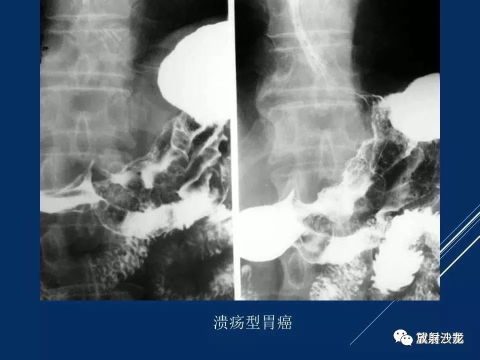 15个病例熟悉胃肠道间质瘤影像表现