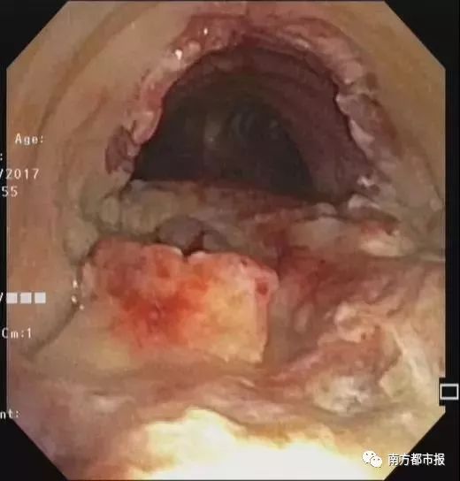 深圳大叔气管里竟"养"了一窝蛆虫!还咳了出来