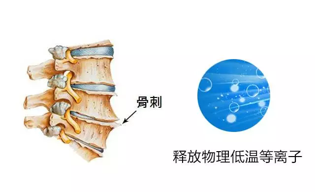 骨刺的原理_根据骨刺产生的原理,错误的力学分布是加速其发生发展的罪魁祸首,所以在日常生