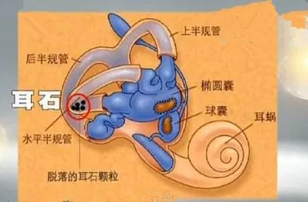 但是,当一些致病因素导致耳石脱落时,这些脱落的耳石就会在内耳内部被
