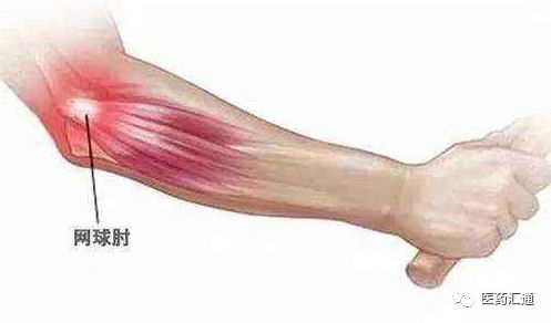 "网球肘(肱骨外上髁炎)是指手肘外侧肌腱发炎而疼痛,疼痛的产生是