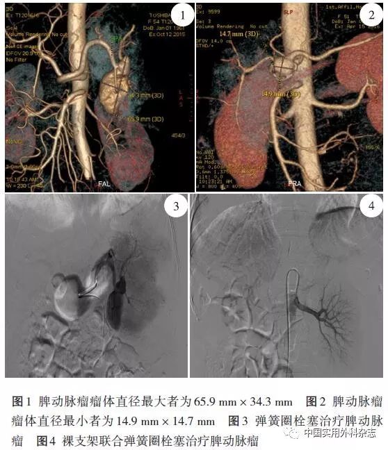 论著脾动脉瘤12例治疗方式选择及疗效分析